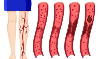 Illustration of Venous Thrombosis